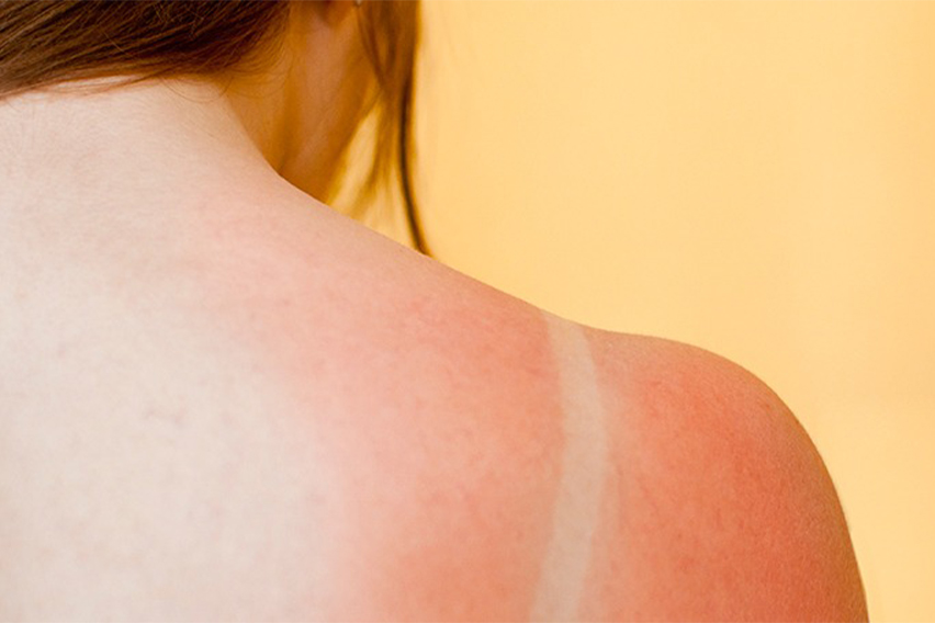 Navigating Sunburn Woes: Practical Tips for Soothing Relief