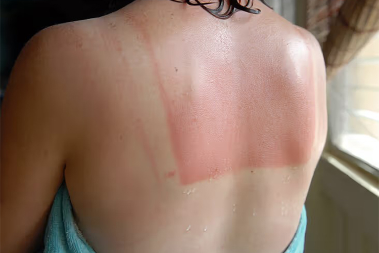 Tips on what to do when you get a sunburn.