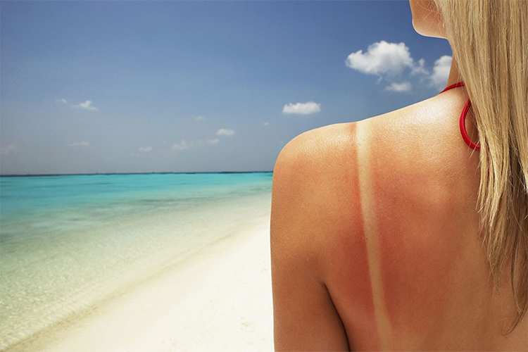 Tips on what to do when you get a sunburn.